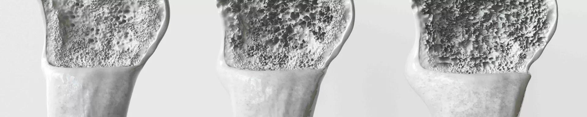 DMP Osteoporose